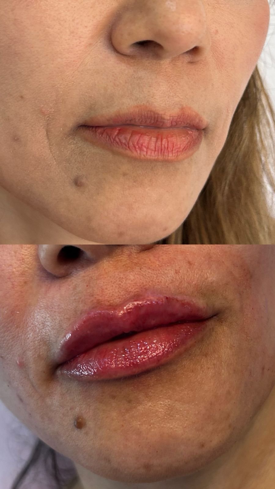Resultado rejuvenescimento